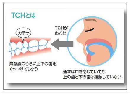 歯ぎしり